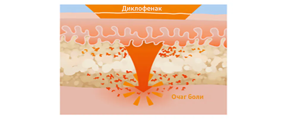 Направленное воздействие на очаг боли и воспаления1,2,5
