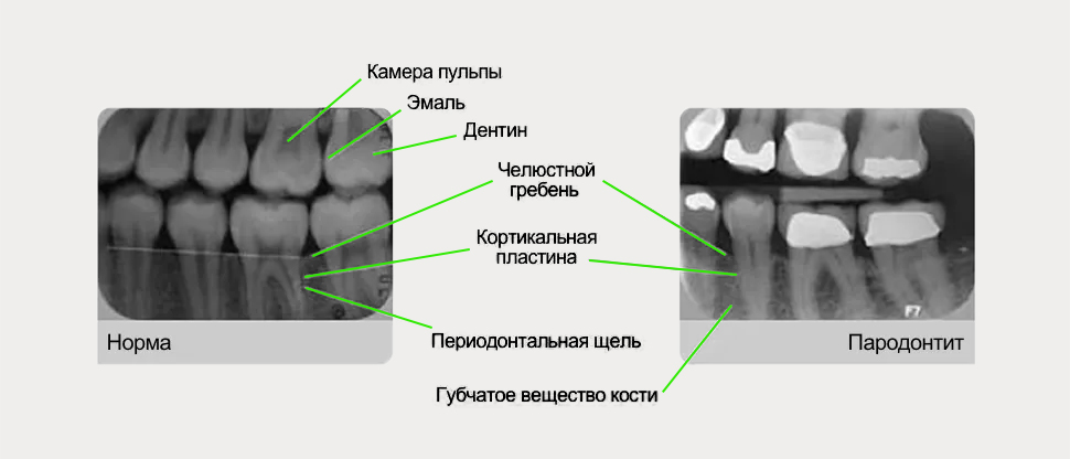 Подробная пародонтологическая карта